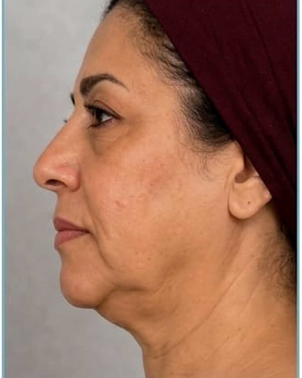 شد الوجه — الحالة الثانية قبل — د. عبير الصياد
