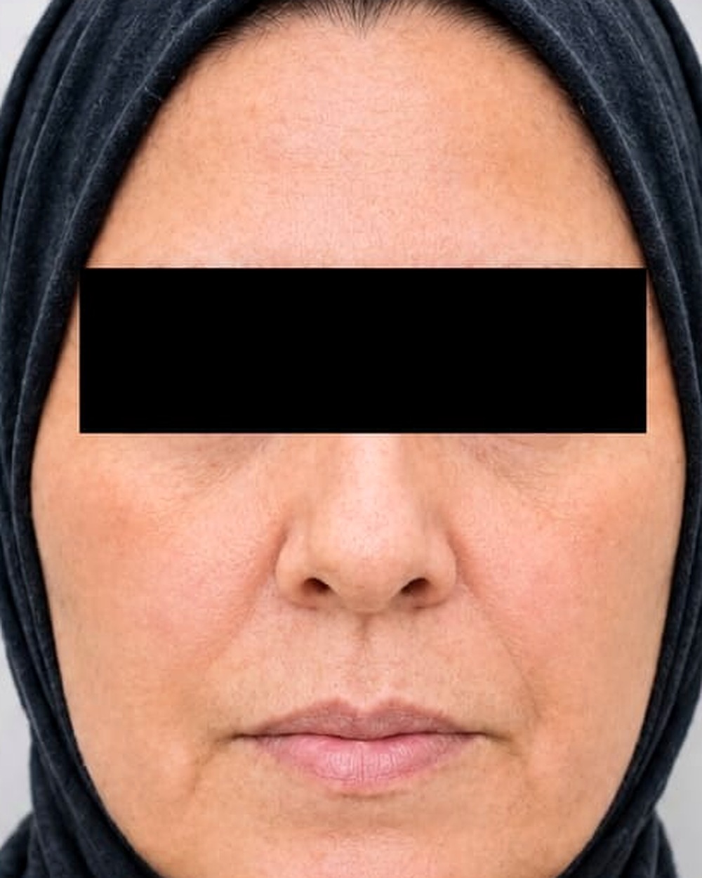 شد الوجه — منظر أمامي بعد — د. عبير الصياد